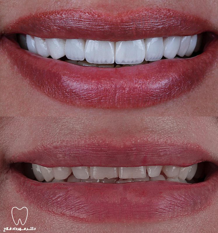 عکس های قبل و بعد از درمان های دندانپزشکی زیبایی