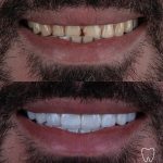 عکس های قبل و بعد از درمان های دندانپزشکی زیبایی