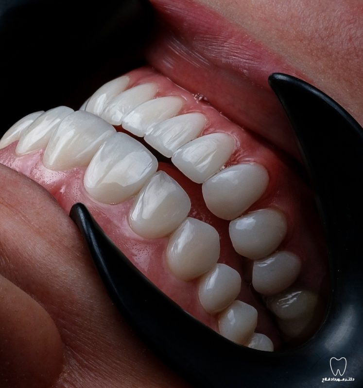 عکس های قبل و بعد از درمان های دندانپزشکی زیبایی