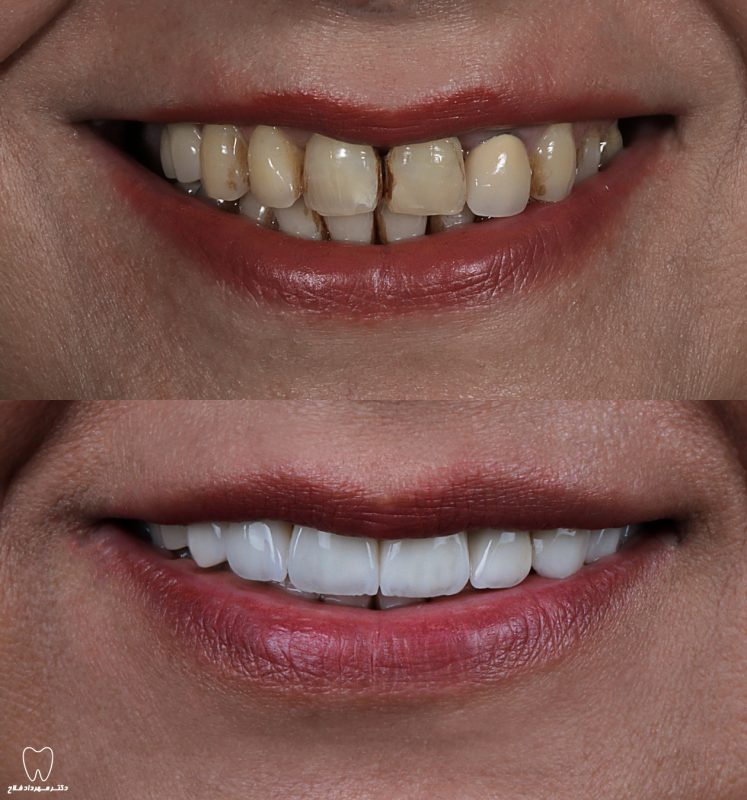 عکس های قبل و بعد از درمان های دندانپزشکی