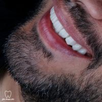 دندانپزشک زیبایی در تهران - طراحی لبخند قبل و بعد