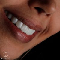 بهترین دندانپزشک زیبایی تهران - نمونه کار کامپوزیت ونیر