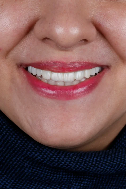 درمان ترکیبی ایمپلنت و لمینت دندان؛ راهکاری نوین برای لبخندی زیبا و ماندگار لبخند کامل و هماهنگ پس از درمان ترکیبی ایمپلنت و لمینت دندان