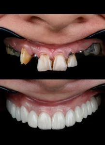 درمان ترکیبی ایمپلنت و لمینت دندان؛ راهکاری نوین برای لبخندی زیبا و ماندگار