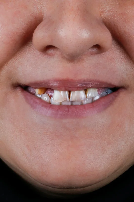 درمان ترکیبی ایمپلنت و لمینت دندان؛ راهکاری نوین برای لبخندی زیبا و ماندگار تصویر قبل از درمان ترکیبی ایمپلنت و لمینت – دندانهای شکسته و فاصلهدار قبل از بازسازی لبخند