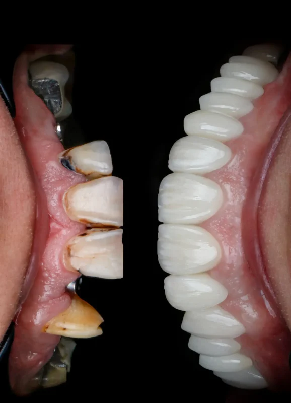 درمان ترکیبی ایمپلنت و لمینت دندان؛ راهکاری نوین برای لبخندی زیبا و ماندگار نمای جانبی درمان ایمپلنت و لمینت – مقایسه قبل و بعد از بازسازی دندانها