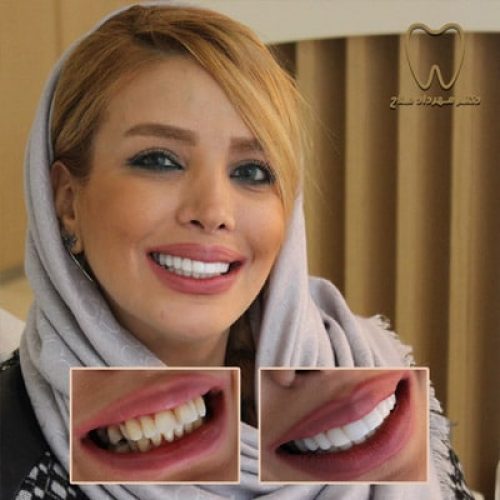 پر کردن دندان با موارد